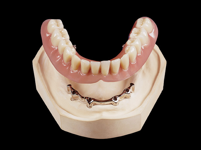 auf-implantatsteg-04