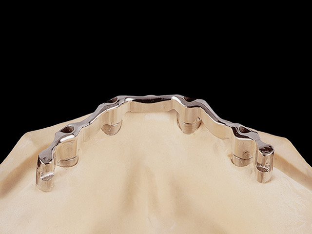 coverdenture-auf-implantatsteg-02