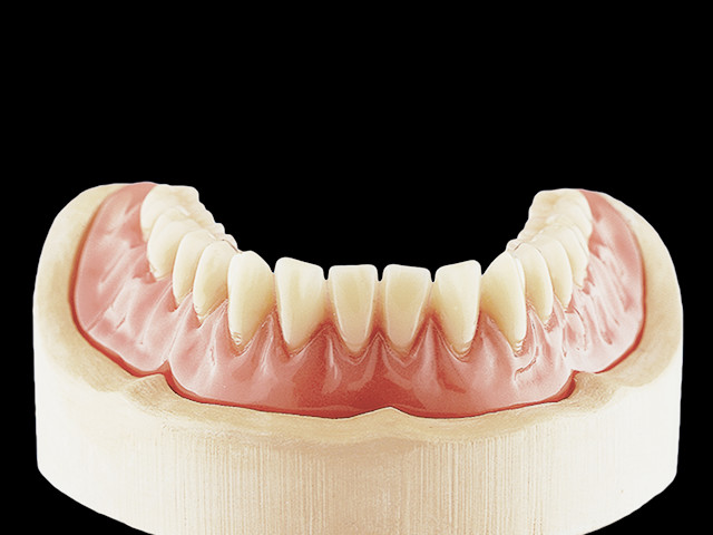 coverdenture-auf-kugelkopfverankerung-02