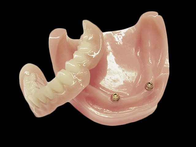 coverdenture-mit-locator-01