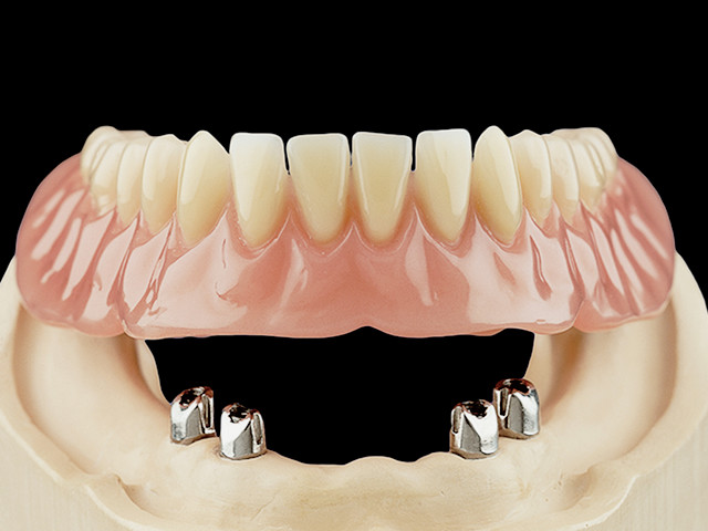 coverdenture-teleskopkronen-auf-implantaten-01