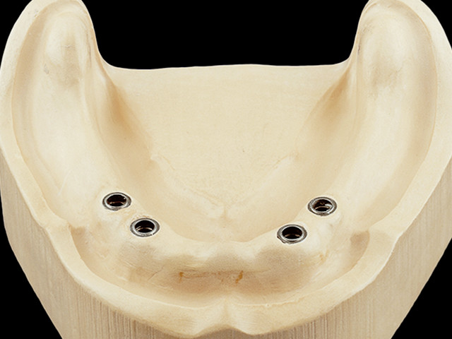 coverdenture-teleskopkronen-auf-implantaten-02