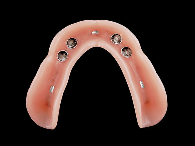 coverdenture-teleskopkronen-auf-implantaten-03