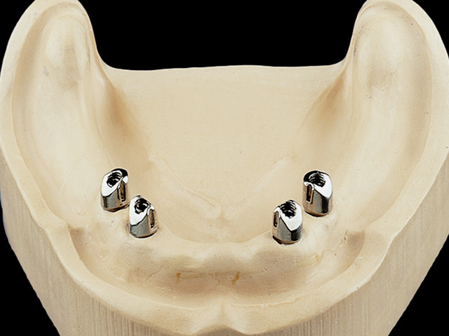coverdenture-teleskopkronen-auf-implantaten-04