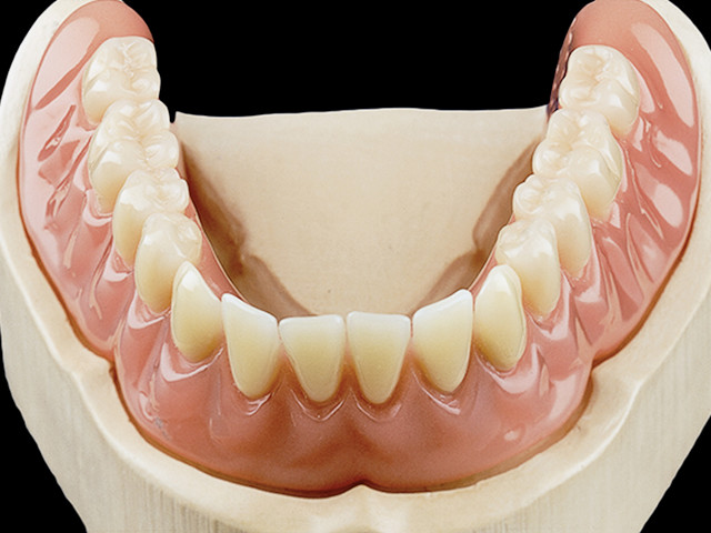 coverdenture-teleskopkronen-auf-implantaten-05