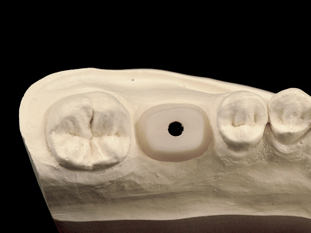 individuelles-abutment-01