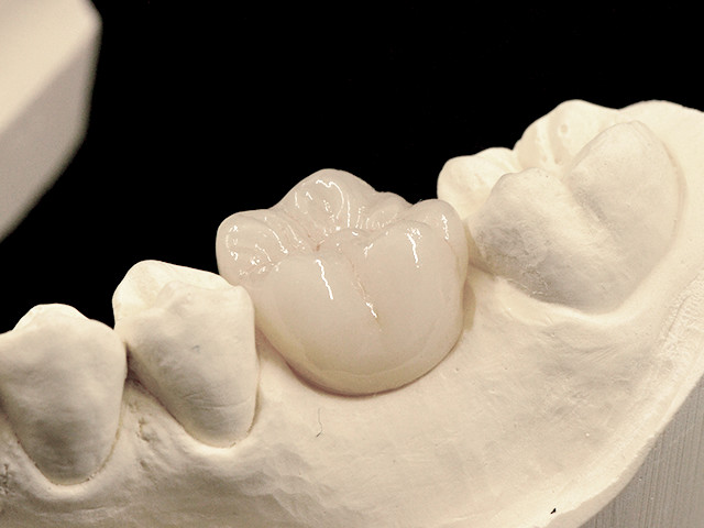 individuelles-abutment-02