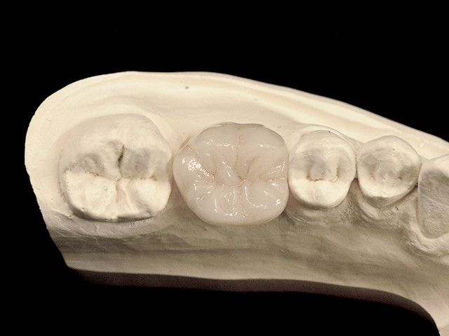 individuelles-abutment-03