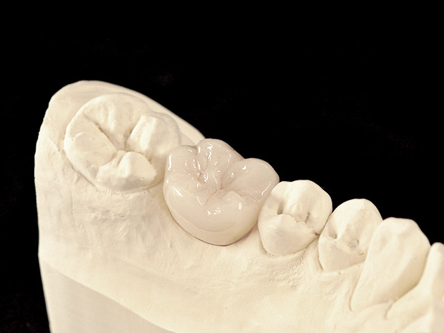 individuelles-abutment-04