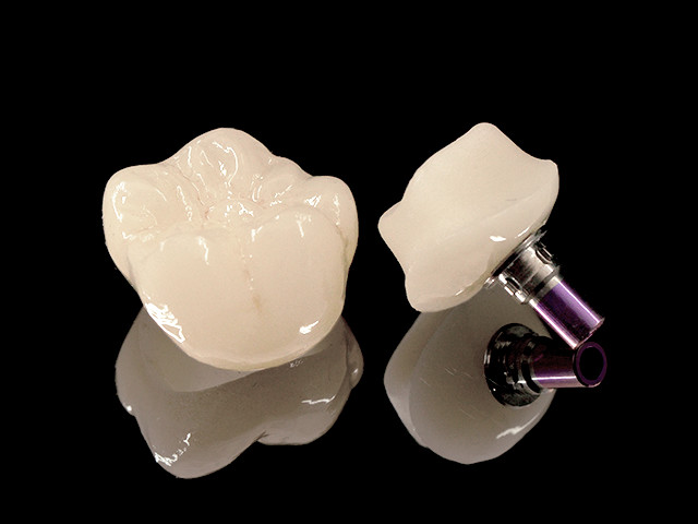 individuelles-abutment-05