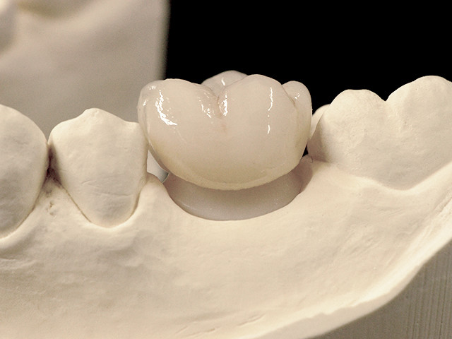 individuelles-abutment-06