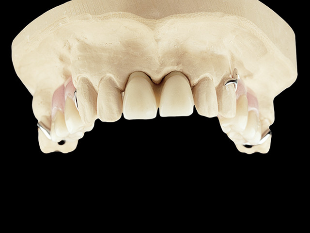 klammerprothese-buegel-02
