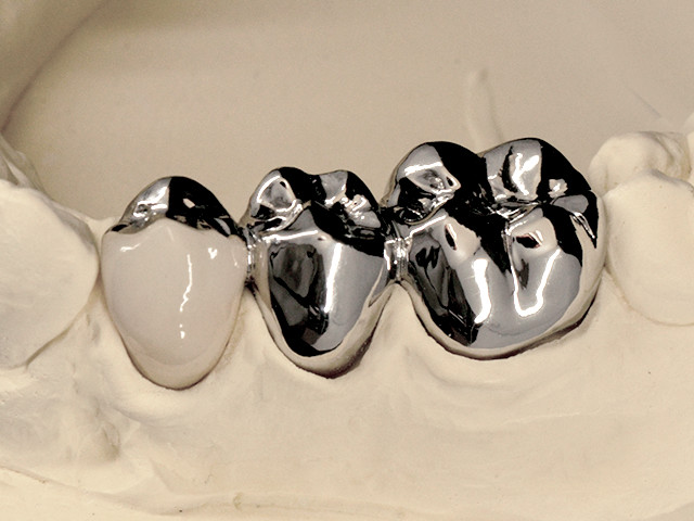 metallkeramik-verblendung-regelversorgung-01