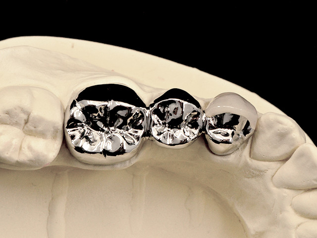 metallkeramik-verblendung-regelversorgung-02