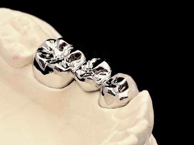 metallkeramik-verblendung-regelversorgung-03