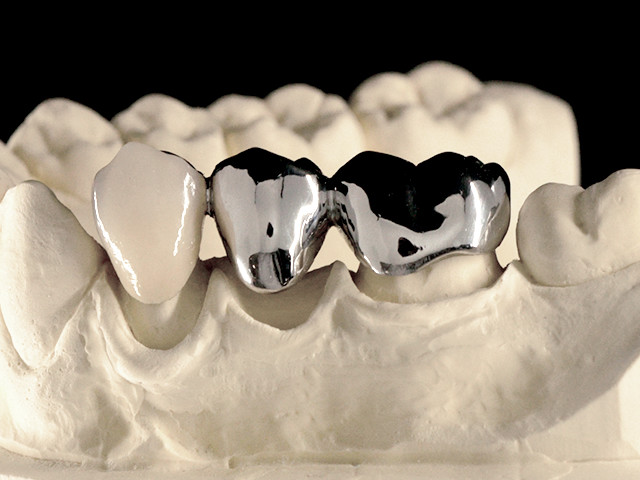 metallkeramik-verblendung-regelversorgung-04
