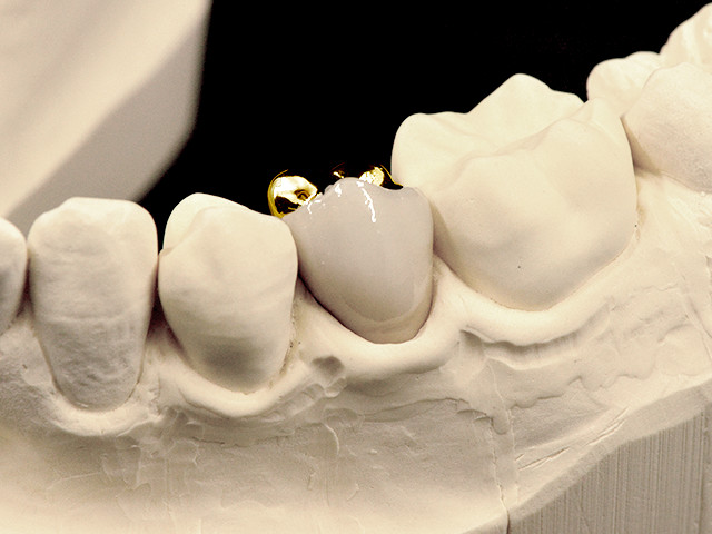 metallkeramik-vestibulaerverbl-gold-01