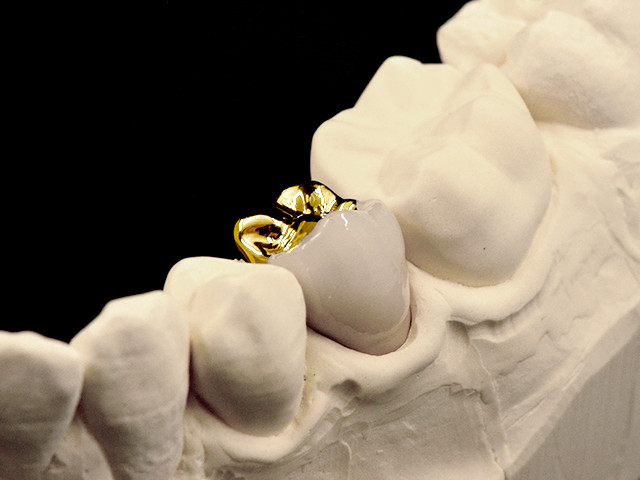 metallkeramik-vestibulaerverbl-gold-02