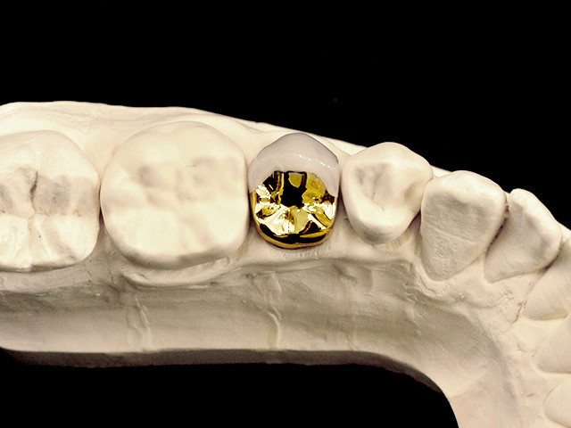 metallkeramik-vestibulaerverbl-gold-03