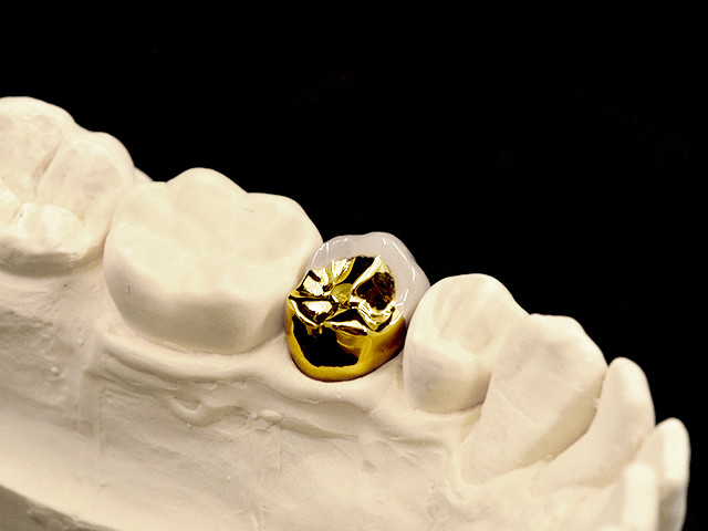 metallkeramik-vestibulaerverbl-gold-04
