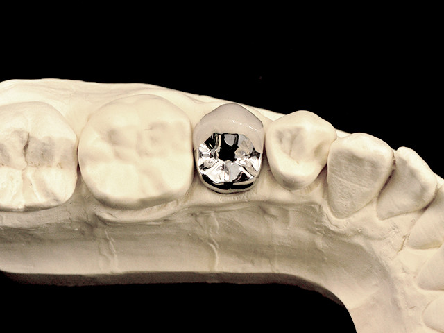 metallkeramik-vestibulaerverbl-nem-03