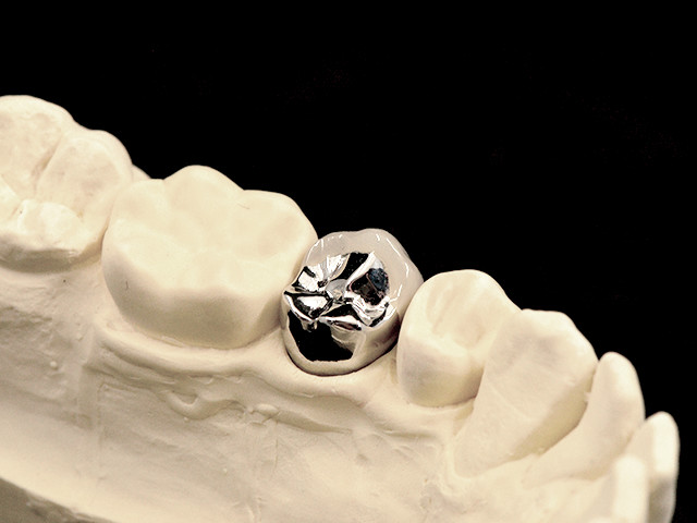 metallkeramik-vestibulaerverbl-nem-04