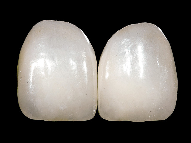 veneers-01