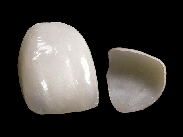 veneers-02