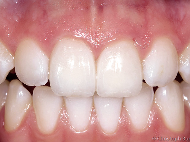 veneers-03