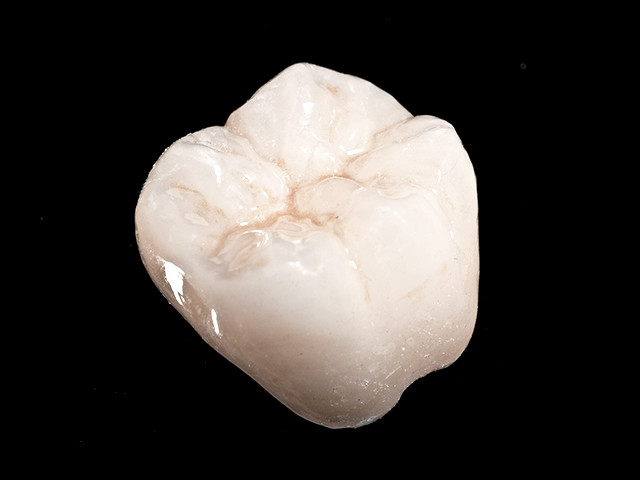 vollkeramik-03